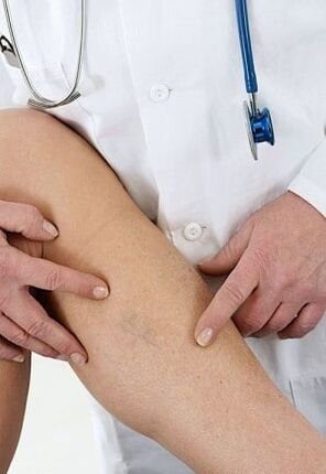 Varikozne vene donjih ekstremiteta