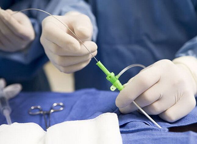 Radiofrekventna ablacija